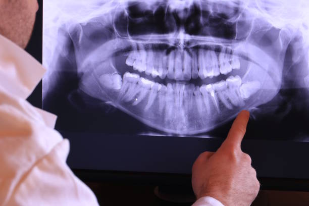 Best Knocked-Out Tooth (Avulsed Tooth) Treatment in Boise, ID